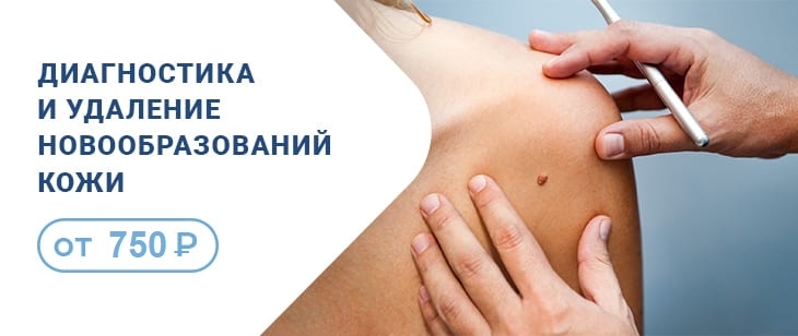 Удаление новообразований кожи